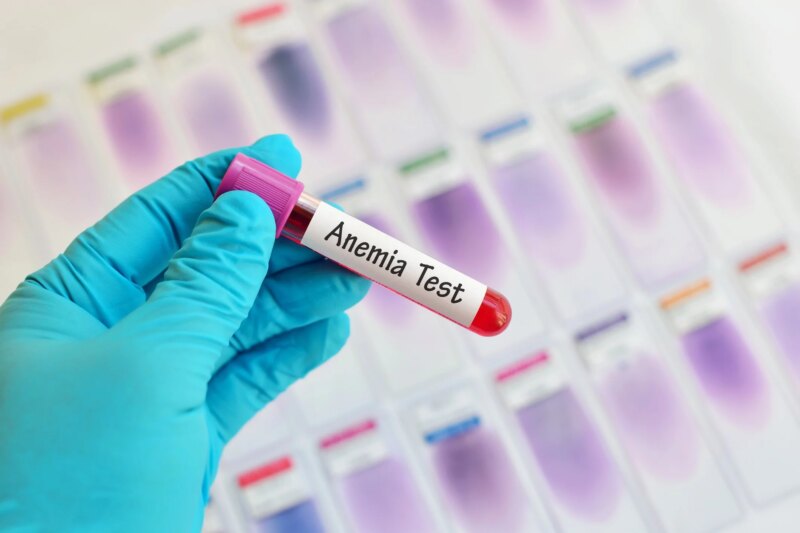 Anemia 1